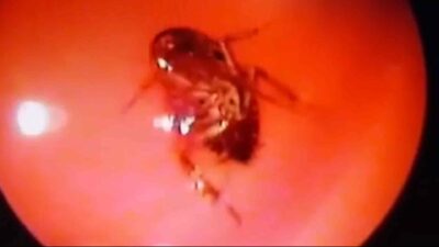 Live Cockroach Removed From Woman'S Head